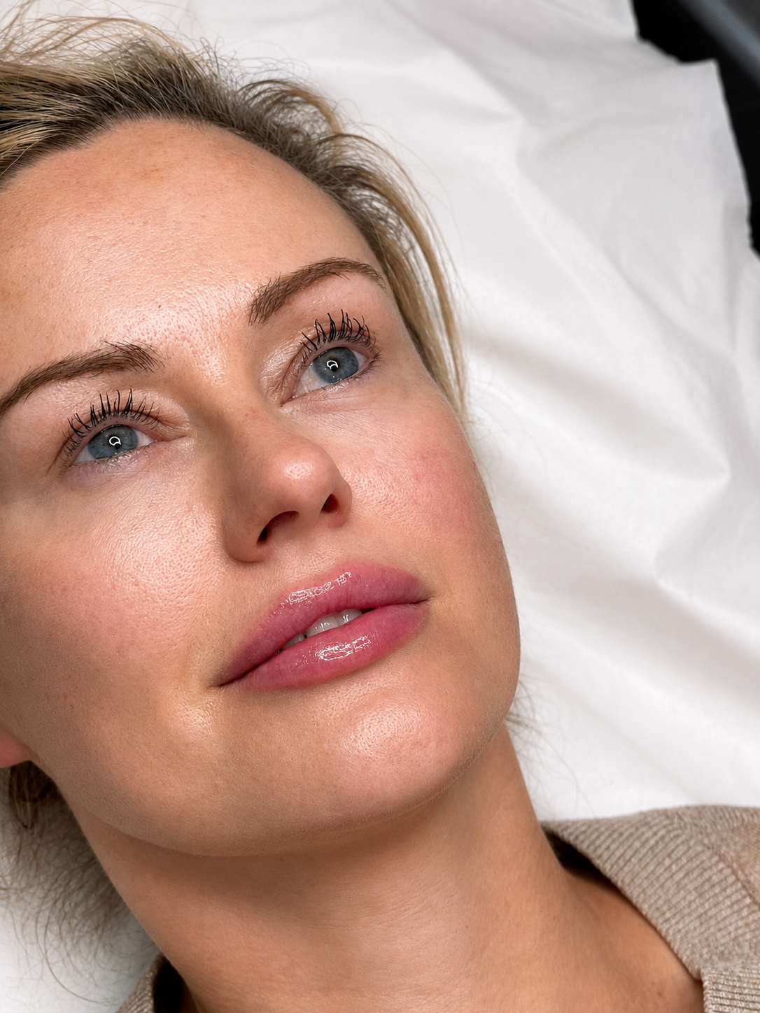 After lip filler treatment